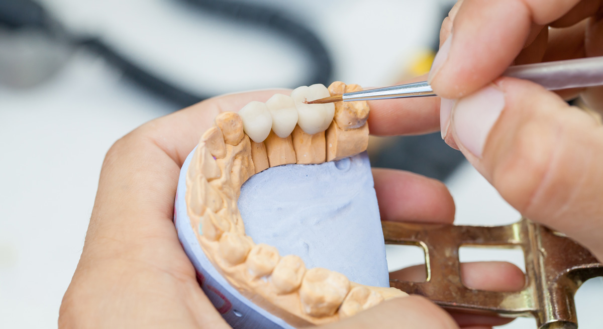 Replacing a Tooth: Explore Your Best Dental Options