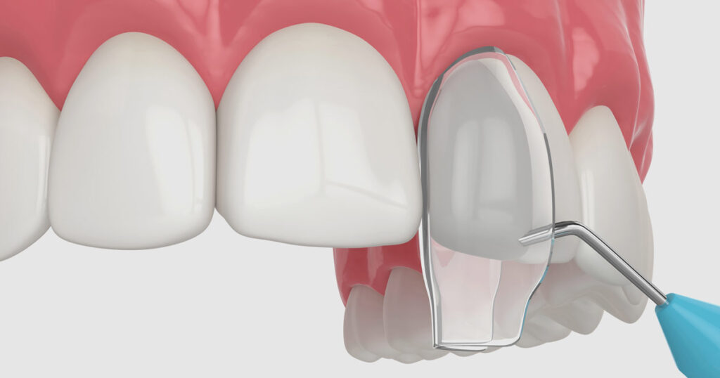 The composite bonding treatment process