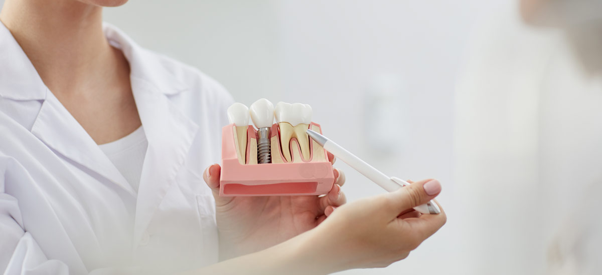 What are dental implants