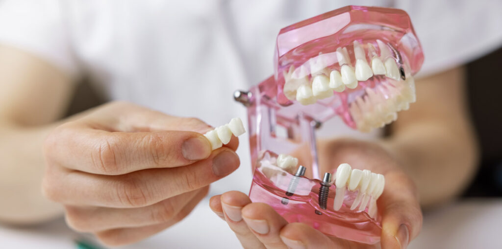 Dental implants
