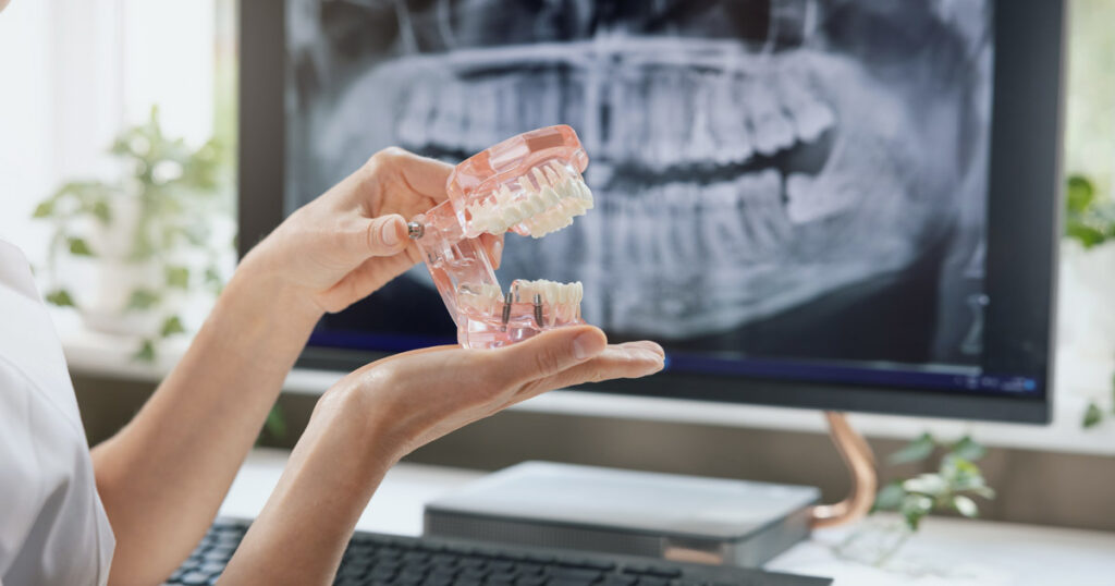 dental implants replacement teeth dentists