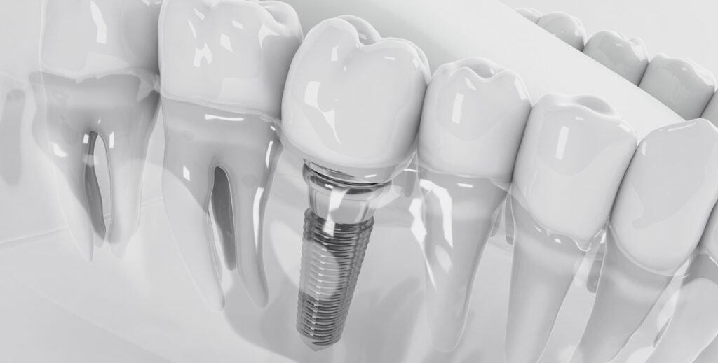 teeth implant everything you need to know