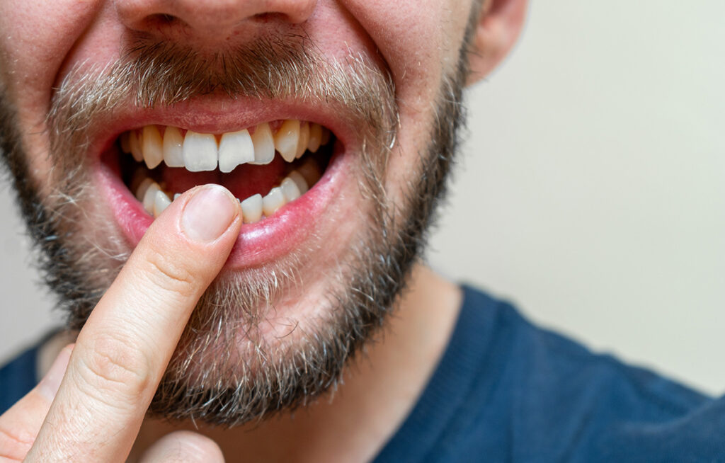 composite bonding for teeth