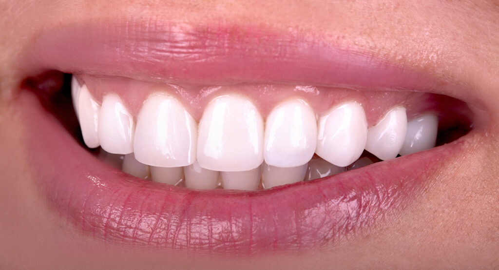 composite bonding for teeth dental finance
