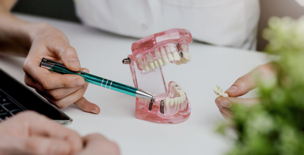dentist model of implant nhs dental implants