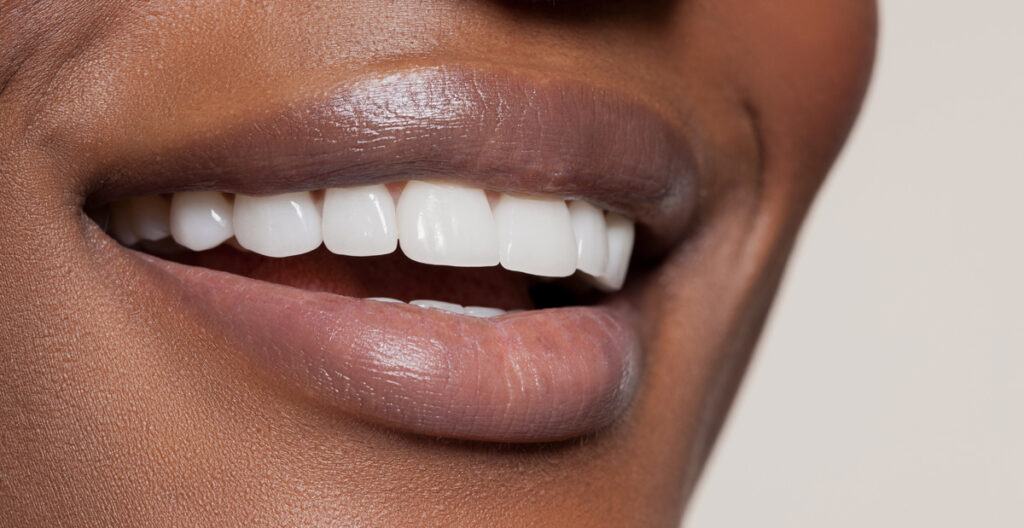 functional benefits of having veneers