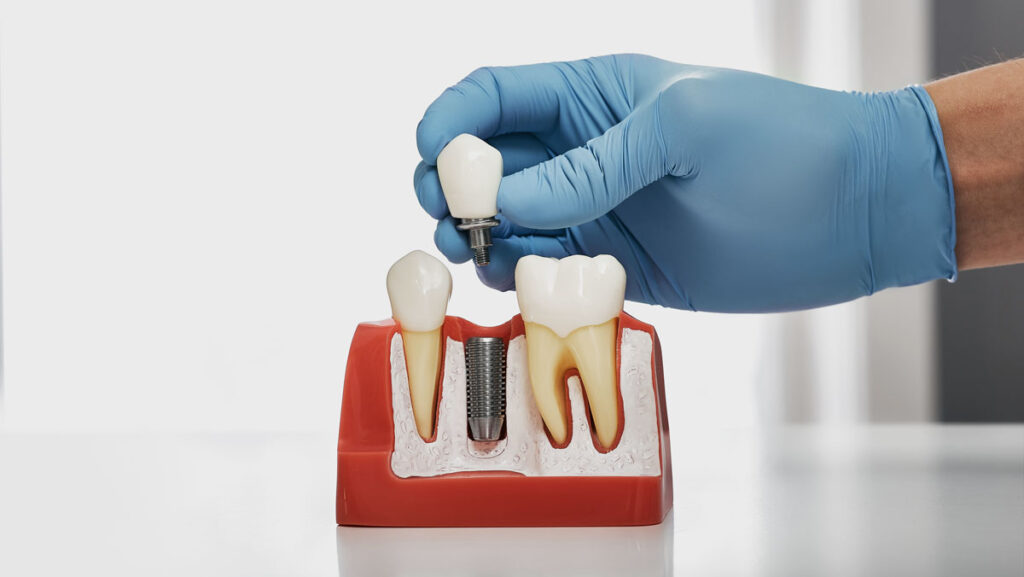 types of dental implants model