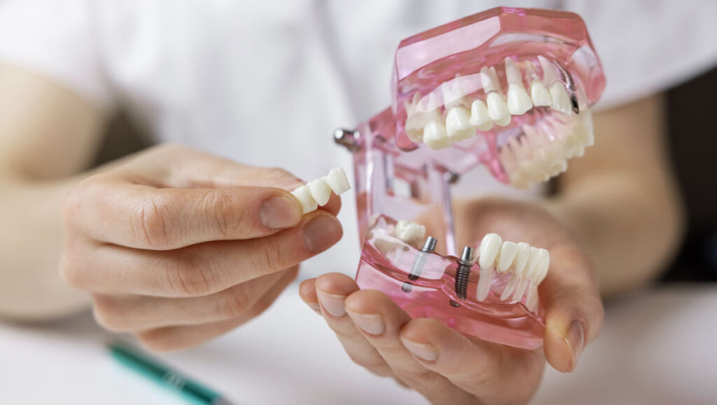 dental implants