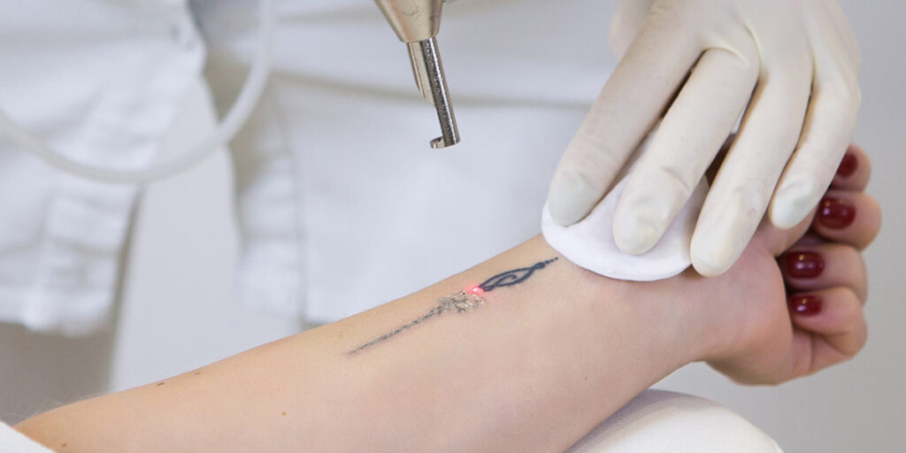 tattoo removal payment plan