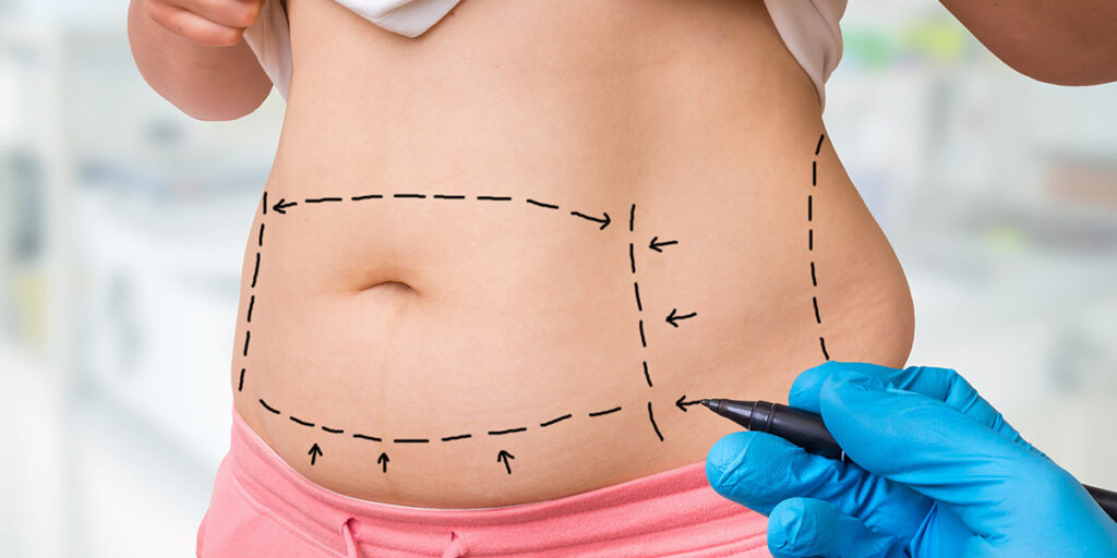 tummy tuck finance